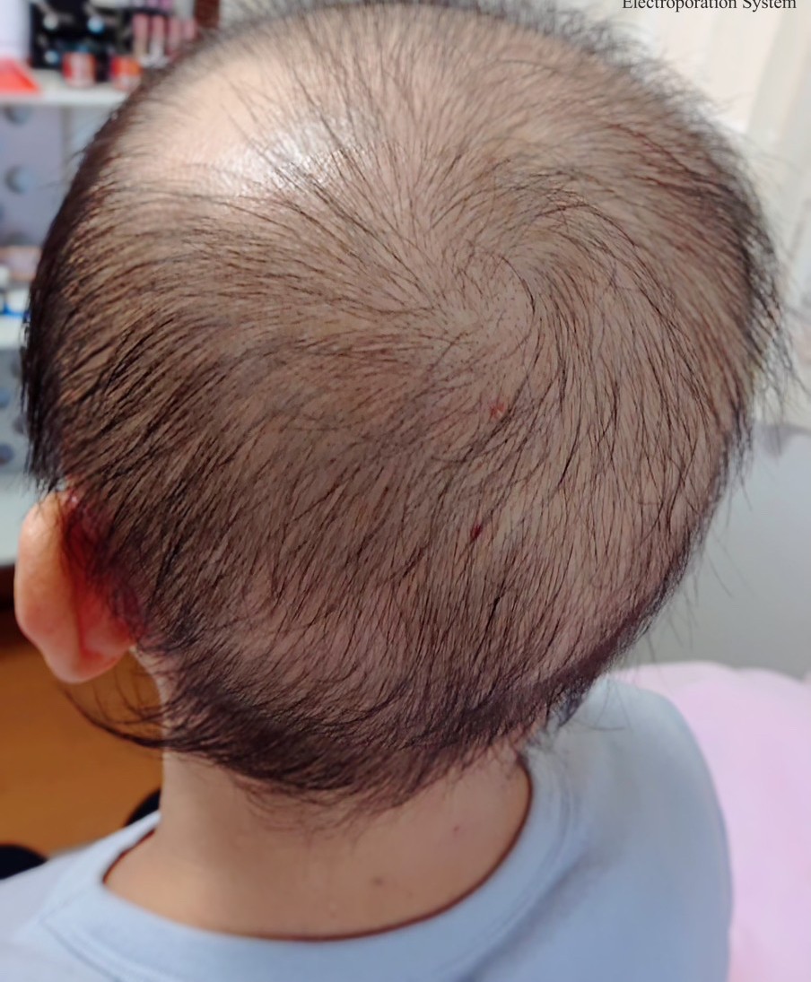 温泉藻RG92配合スカルプケア施術後の頭皮改善効果