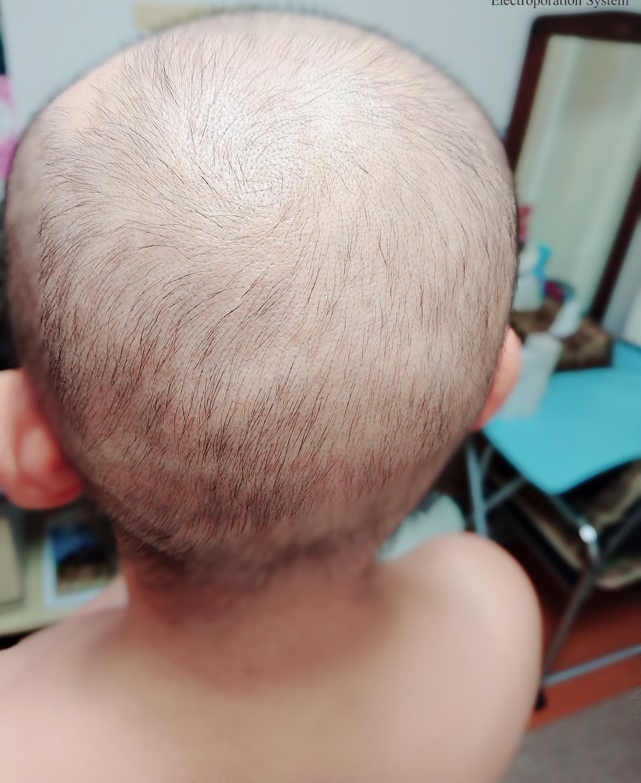 頭皮スコープで見る施術前の毛穴状態｜エレクトロポレーション